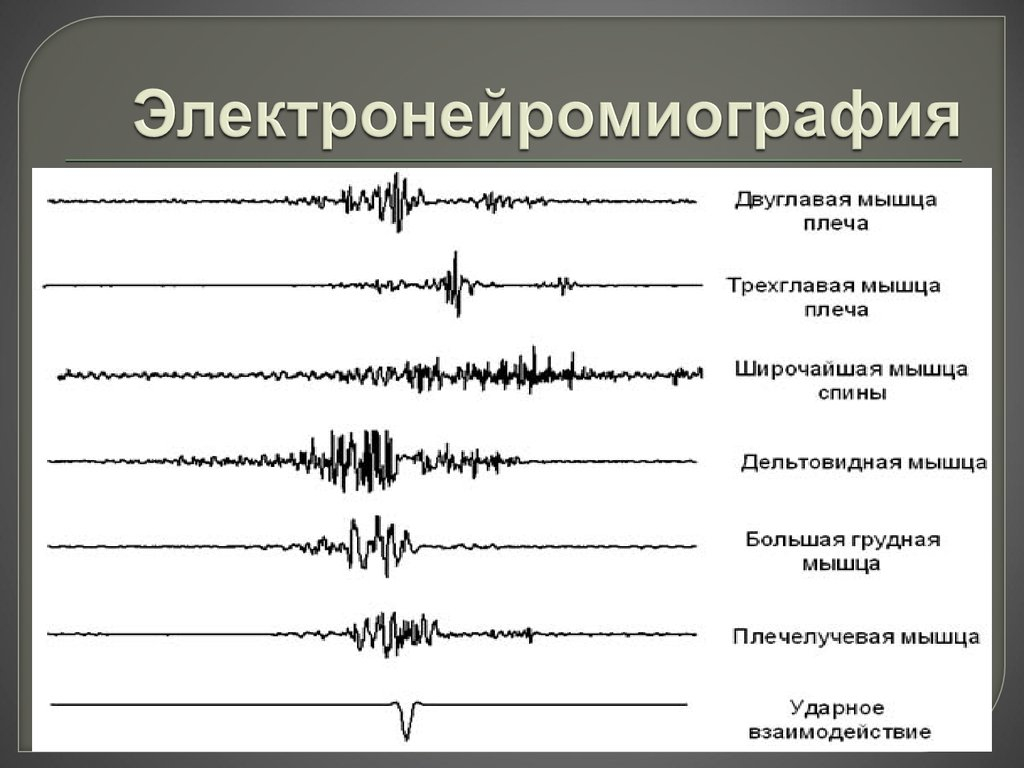 электронейромиография нижних конечностей